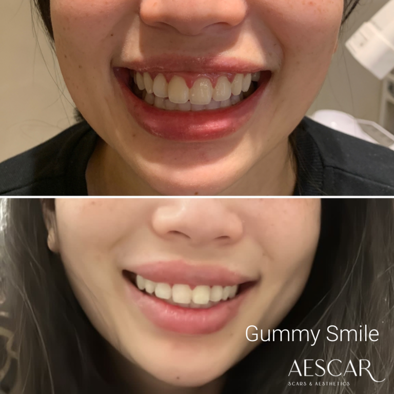 Anti-Wrinkle Aescar Scar & Aesthetics Skin Clinic Melbourne Cosmetic Injectables