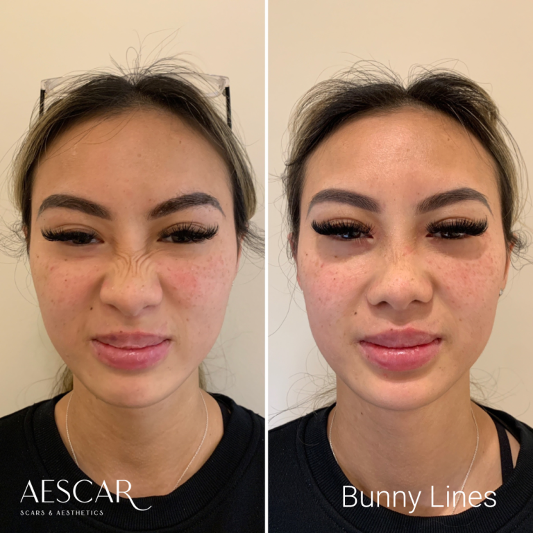 Anti-Wrinkle Aescar Scar & Aesthetics Skin Clinic Melbourne Cosmetic Injectables