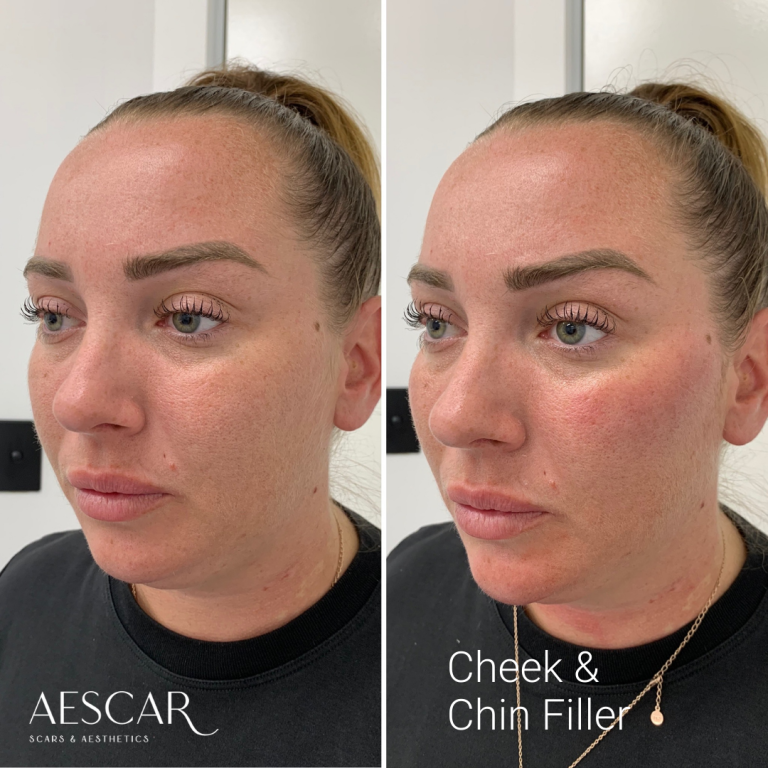 Dermal Filler Aescar Scar & Aesthetics Skin Clinic Melbourne Cosmetic Injectables