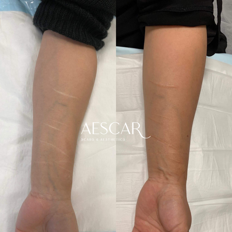 Aescar Scar & Aesthetics Skin Clinic Melbourne Cosmetic Injectables