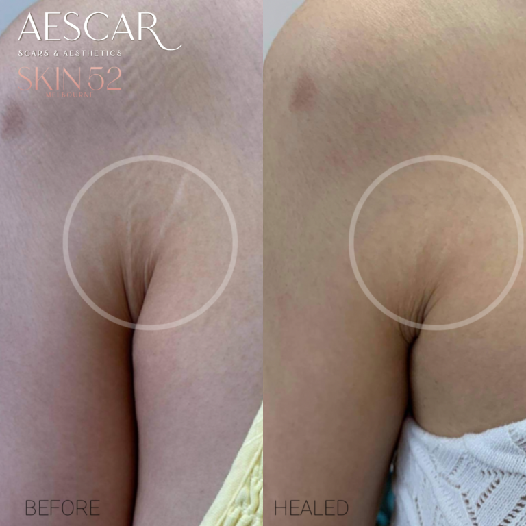Aescar Scar & Aesthetics Skin Clinic Melbourne Cosmetic Injectables