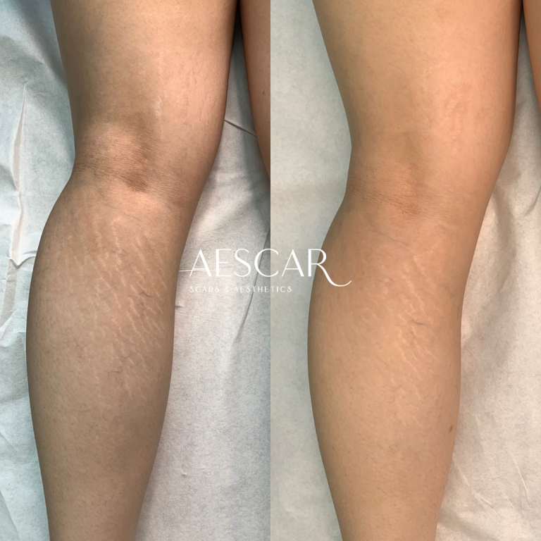Aescar Scar & Aesthetics Skin Clinic Melbourne Cosmetic Injectables